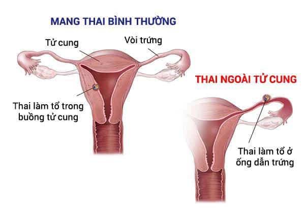 thai-ngoai-tu-cung-1-15630645004021676980877.jpg