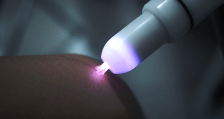 tia plasma