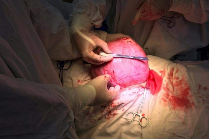 Hình ảnh khối u sau khi đc phẫu thuật. Ảnh: BSCC