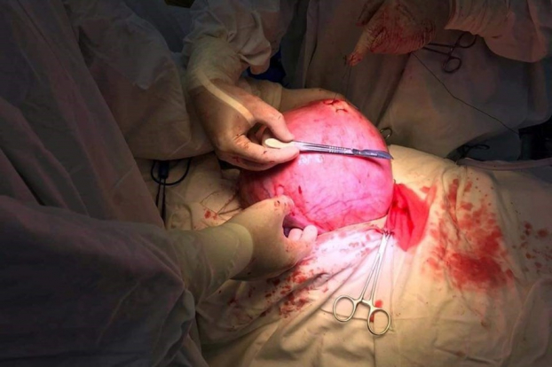   Các bác sĩ tiến hành cắt bỏ khối u xơ tử cung to bằng thai nhi 9 tháng  