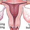 Những điều cần biết về ung thư buồng trứng