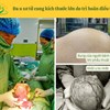 Đa u xơ tử cung kích thước lớn do trì hoãn điều trị