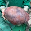 Phẫu thuật thành công cho nữ bệnh nhân 57 tuổi mang khối u buồng trứng khổng lồ nặng 7kg