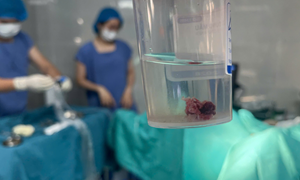 Phát hiện hiếm gặp: Bé gái 14 tuổi mắc đa Polyp buồng tử cung 