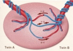 Ứng dụng kỹ thuật sinh học phân tử và kỹ thuật laser quang đông trong điều trị hội chứng truyền máu song thai và dải xơ buồng ối