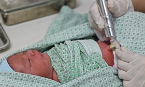 Chiếu tia plasma cuống rốn cho trẻ sơ sinh