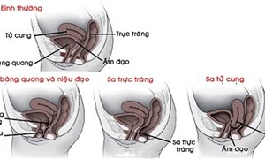 TẠI SAO PHẢI KHÁM SÀN CHẬU SAU SINH