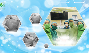 23 tuổi, mang khối u xơ tử cung 36cm mà không hề hay biết – cảnh báo từ một ca bệnh có thật