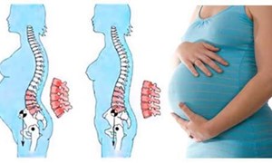 Đau lưng khi mang thai: nguyên nhân và cách giảm đau hiệu quả cho mẹ bầu