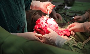 Phát hiên khối u 30cm từ lần khám sức khoẻ