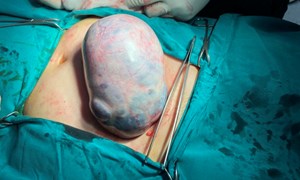 70 tuổi mang khối u buồng trứng nặng trên 2kg