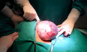 Xem tận mắt clip em bé sinh ra còn nằm trong túi ối do bác sĩ Bệnh viện Phụ Sản Hà Nội chia sẻ, các mẹ chỉ biết thốt lên 2 từ: Kỳ diệu!