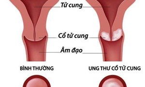 Ung thư cổ tử cung - căn bệnh nguy hiểm đang trẻ hoá nhưng hoàn toàn có thể phòng ngừa