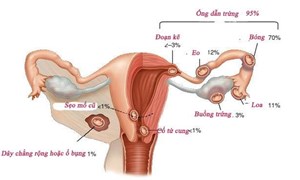 Thai ngoài tử cung - biến chứng sản khoa nguy hiểm cần phát hiện sớm