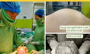 Đa u xơ tử cung kích thước lớn do trì hoãn điều trị