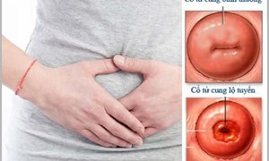 Lộ tuyến cổ tử cung có gây ung thư và vô sinh không?