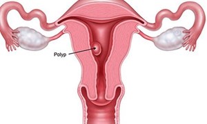 Rong kinh kéo dài, người phụ nữ nhập viện trong tình trạng kiệt sức