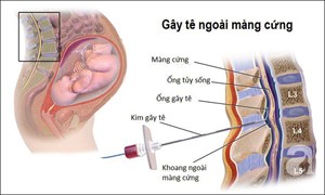 Đẻ không đau - giảm đau trong đẻ