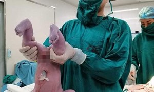 Bệnh viện Phụ sản Hà Nội đón bé sơ sinh nặng hơn nửa yến