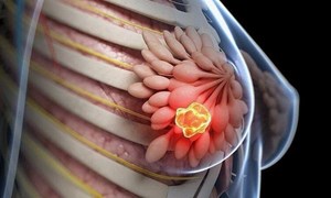 Khám và sàng lọc ung thư vú – Chủ động bảo vệ sức khỏe 