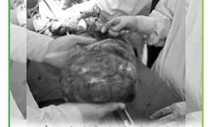 Bệnh viện Phụ sản Hà Nội phẫu thuật thành công cho người bệnh có khối u xơ tử cung nặng 4kg