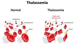 Thalassemia là gì