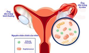 Bệnh nhân 14 tuổi viêm ứ mủ vòi tử cung dạng áp xe phần phụ