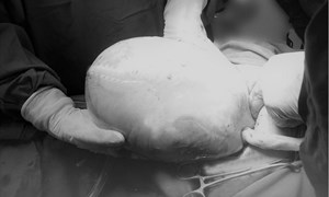 Một bé trong ca sinh đôi còn nguyên trong bọc ối lúc chào đời