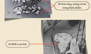 Khi u nang buồng trứng tiến triển thành u quái 