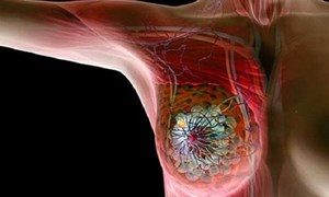 Phụ nữ nên cảnh giác với ung thư vú khi bước sang ngưỡng tuổi 30