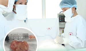 Phẫu thuật bóc tách u nang tuyến vú ra về trong ngày
