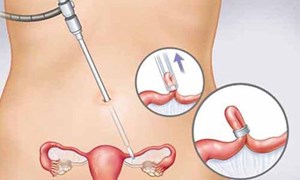 Phẫu thuật nội soi, giải pháp an toàn trong điều trị u buồng trứng