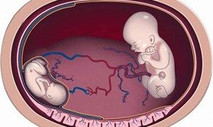 Hội chứng truyền máu song thai là gì?