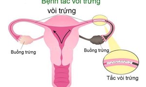 Hiếm muộn do tắc vòi trứng, chị em phải làm gì?