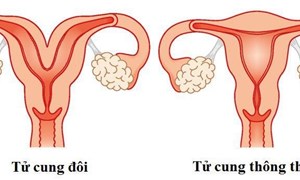 Bệnh tử cung đôi là gì?