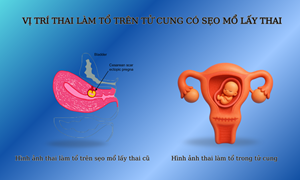 Thai bám sẹo mổ cũ là gì? (Chửa vết mổ lấy thai là gì?)