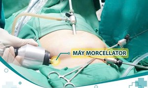 Phẫu thuật nội soi bóc u xơ tử cung với thiết bị hỗ trợ 