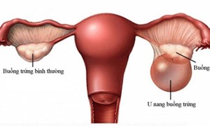 U nang buồng trứng, triệu chứng, chẩn đoán và điều trị 
