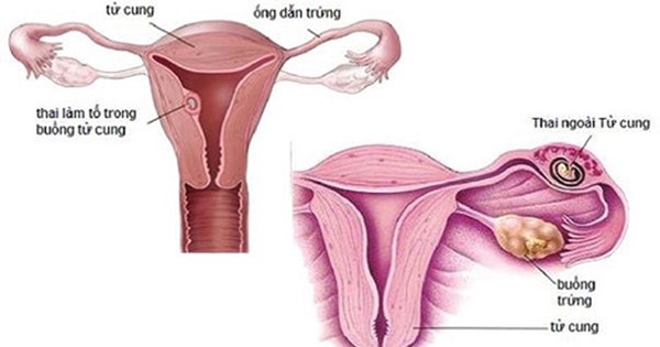 Thai ngoài tử cung là gì?
