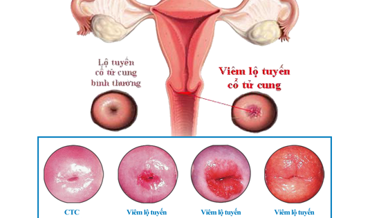 Làm thế nào để giảm thiểu mức độ ra máu sau khi đốt lộ tuyến cổ tử cung?
