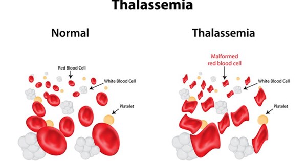 Những tác động và hệ quả của bệnh alpha thalassemia thể nhẹ là gì?
