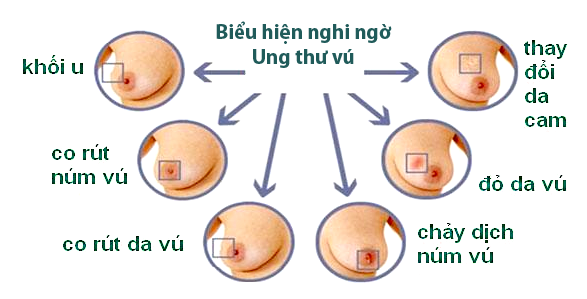 Chế độ ăn uống hợp lý có vai trò gì trong điều trị nang vú?
