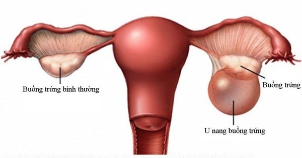 Có những dấu hiệu cảnh báo hay bệnh nền nào khiến người mắc bệnh u nang buồng trứng có nguy cơ mắc các bệnh liên quan?