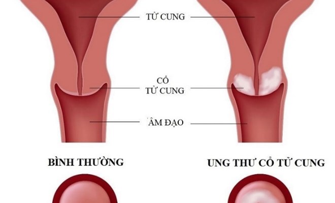 Sàng lọc ung thư cổ tử cung, tiêm phòng vắc xin - giải pháp hiệu quả bảo vệ sức khoẻ sinh sản 
