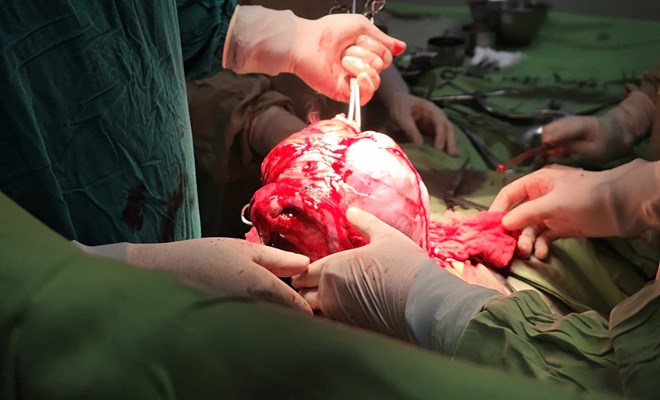 Phát hiên khối u 30cm từ lần khám sức khoẻ