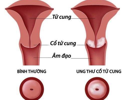 Ung thư cổ tử cung - căn bệnh nguy hiểm đang trẻ hoá nhưng hoàn toàn có thể phòng ngừa
