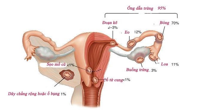 Thai ngoài tử cung - biến chứng sản khoa nguy hiểm cần phát hiện sớm