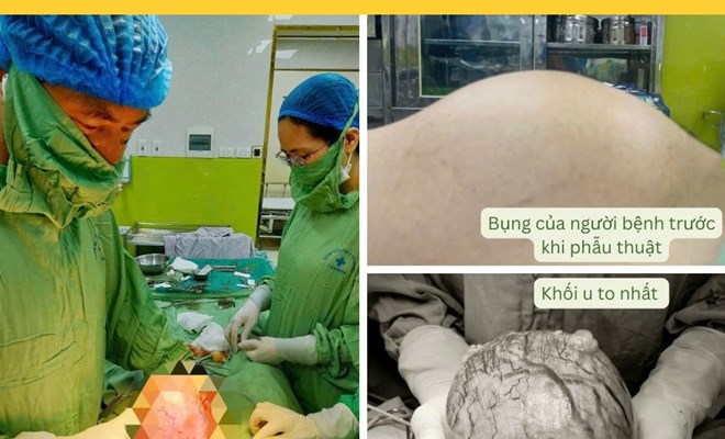 Đa u xơ tử cung kích thước lớn do trì hoãn điều trị