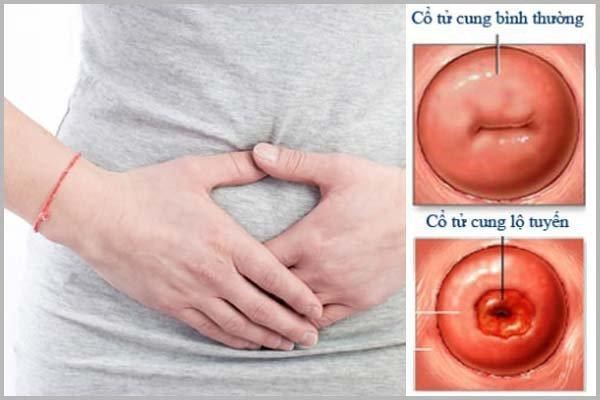 Lộ tuyến cổ tử cung có gây ung thư và vô sinh không?