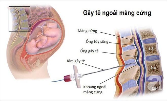 Đẻ không đau - giảm đau trong đẻ